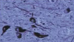 正凡人：黑质神经元保存