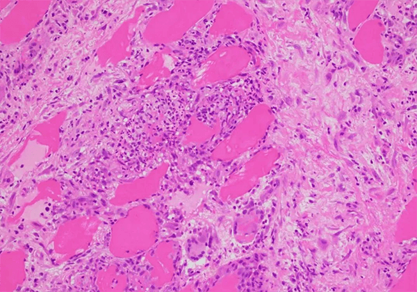 【人生就是博官方网站助力】治疗结节病的KBMAB-16获FDA批准临床